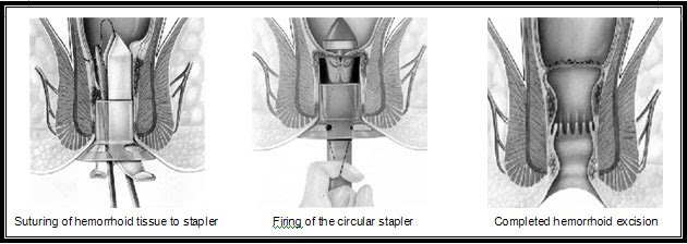 Hemorrhoidectomy | UCSF Department of Surgery