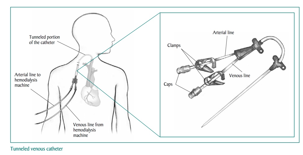 Tunneled Venous Catheter